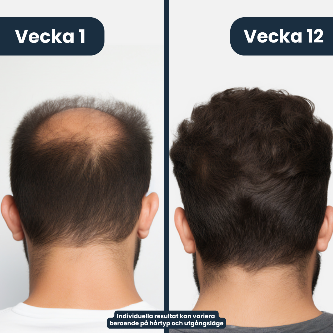 ReRoot™ - Stoppa håravfallet utan dyra klinikbesök